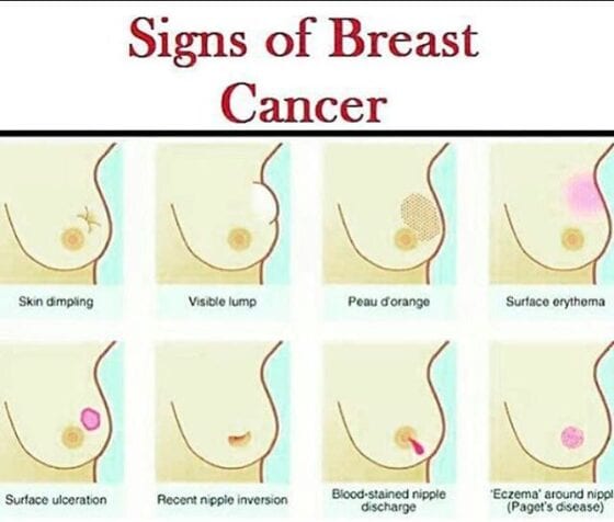Warning signs of breast cancer in women