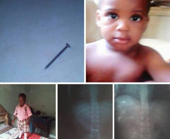 Nail removes itself from baby's intestine without surgery